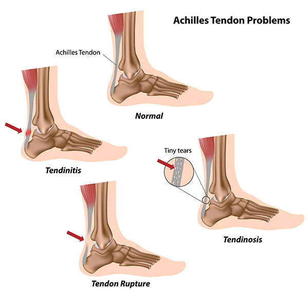 Ankle Pain in Lantana