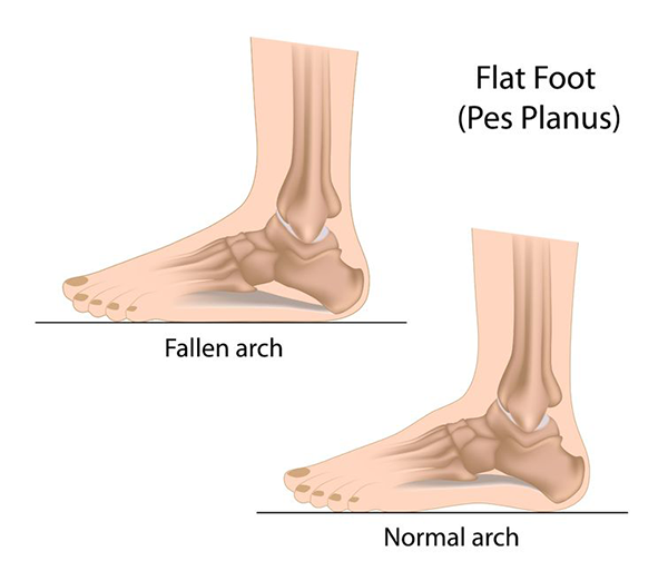 Foot and Ankle Supportive Devices in Lantana